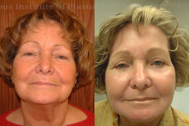 Phenol Chemical Peel before and after photo by Columbus Institute of Plastic Surgery in Columbus, OH
