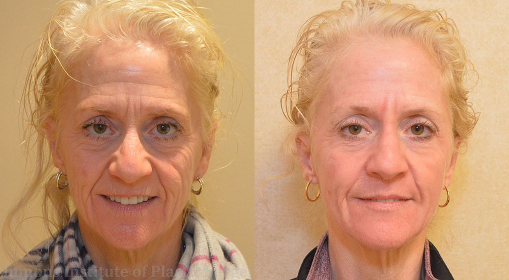 Phenol Chemical Peel before and after photo by Columbus Institute of Plastic Surgery in Columbus, OH