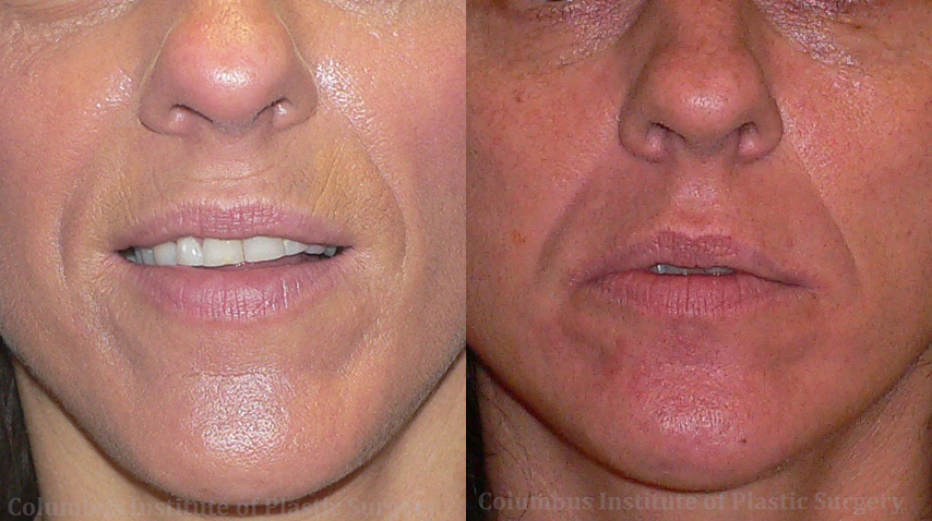 Phenol Chemical Peel before and after photo by Columbus Institute of Plastic Surgery in Columbus, OH