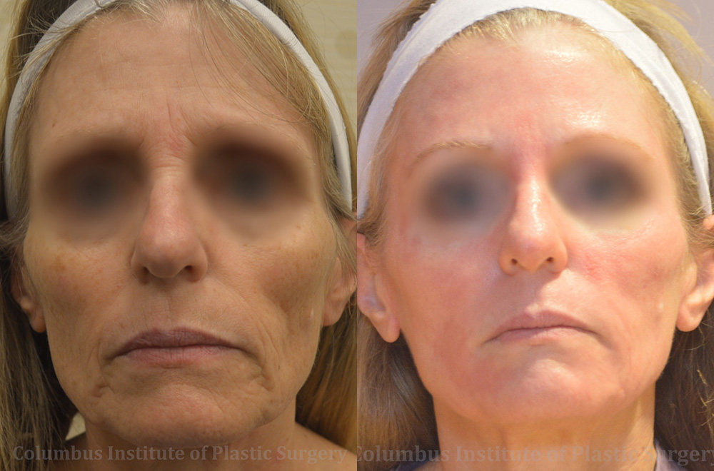 Phenol Chemical Peel before and after photo by Columbus Institute of Plastic Surgery in Columbus, OH