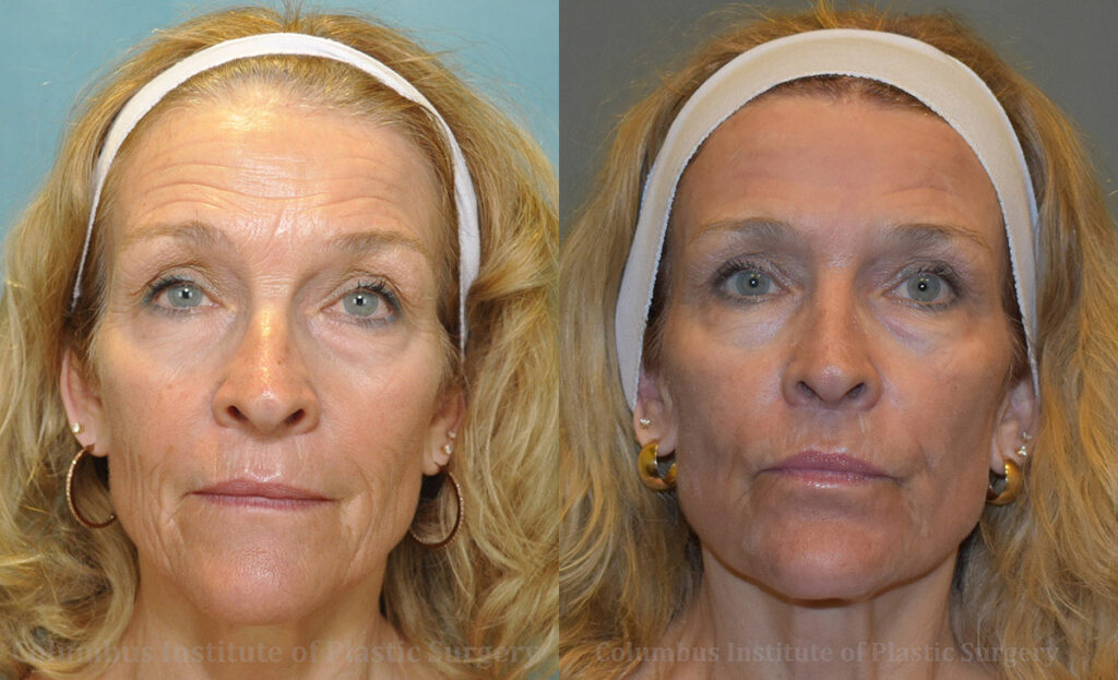 Phenol Chemical Peel before and after photo by Columbus Institute of Plastic Surgery in Columbus, OH