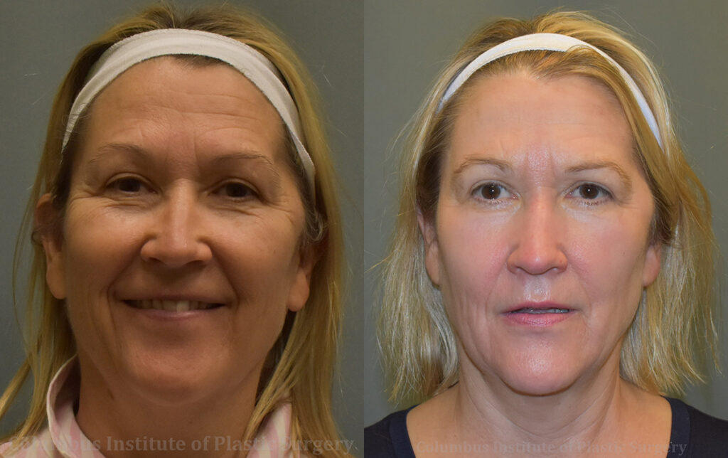Phenol Chemical Peel before and after photo by Columbus Institute of Plastic Surgery in Columbus, OH