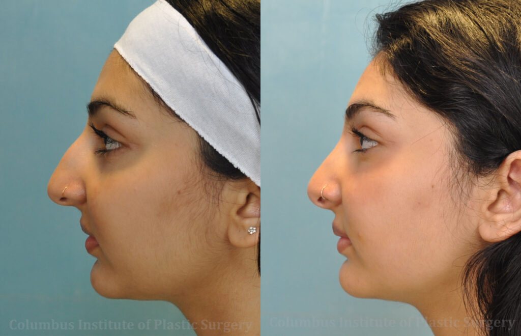 Rhinoplasty/Septoplasty before and after photo by Columbus Institute of Plastic Surgery in Columbus, OH