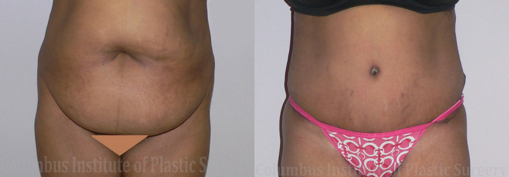 Abdominoplasty (Tummy Tuck) before and after photo by Columbus Institute of Plastic Surgery in Columbus, OH