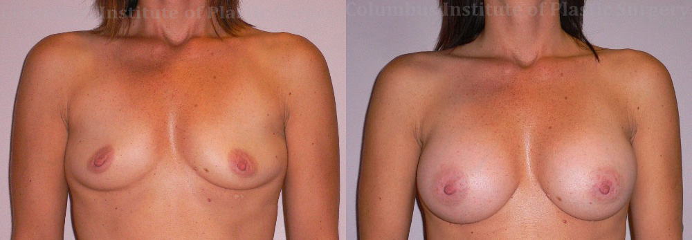 Breast Augmentation – 300cc-400cc before and after photo by Columbus Institute of Plastic Surgery in Columbus, OH