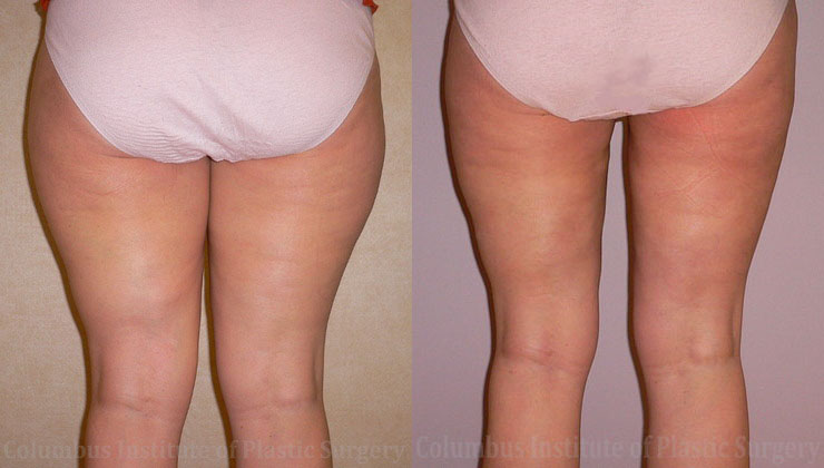 Liposuction before and after photo by Columbus Institute of Plastic Surgery in Columbus, OH