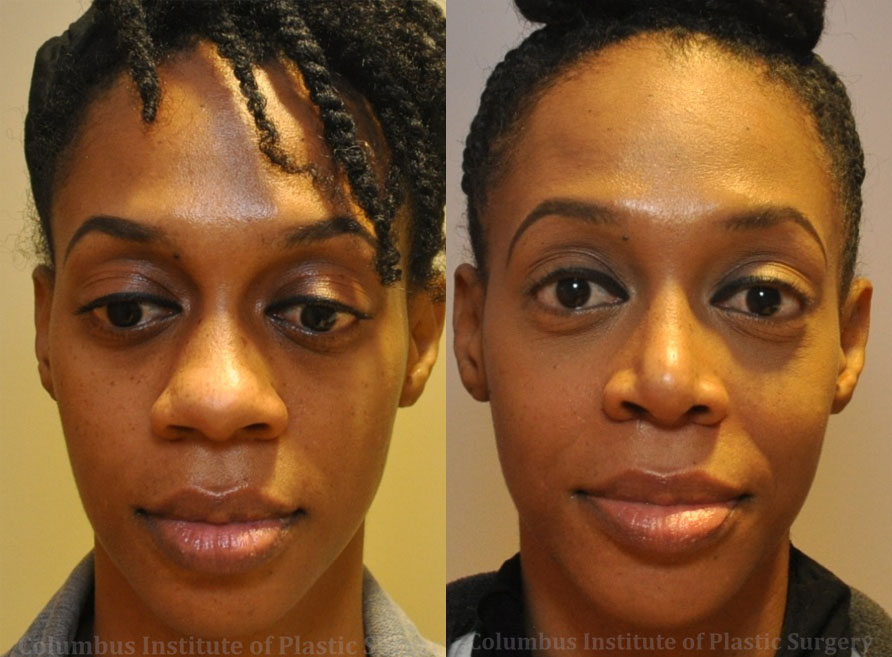 Rhinoplasty/Septoplasty before and after photo by Columbus Institute of Plastic Surgery in Columbus, OH