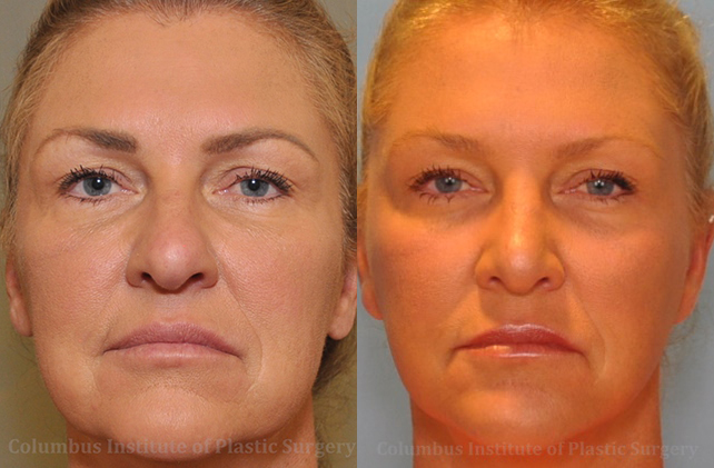 Rhinoplasty/Septoplasty before and after photo by Columbus Institute of Plastic Surgery in Columbus, OH