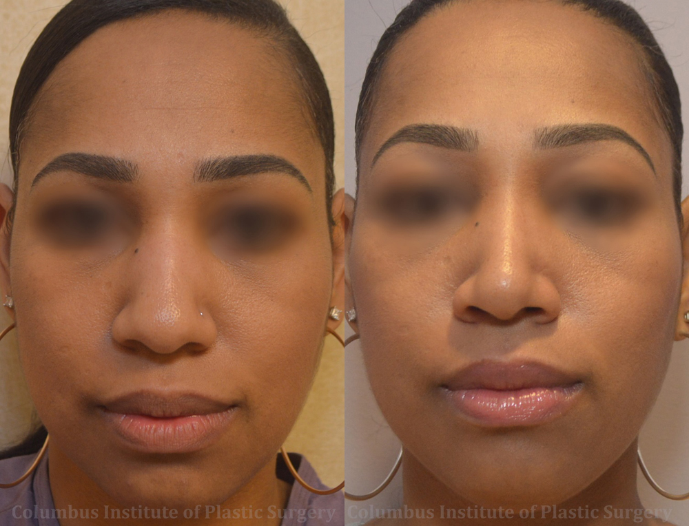 Rhinoplasty/Septoplasty before and after photo by Columbus Institute of Plastic Surgery in Columbus, OH