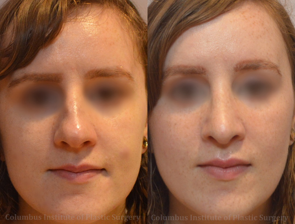 Rhinoplasty/Septoplasty before and after photo by Columbus Institute of Plastic Surgery in Columbus, OH