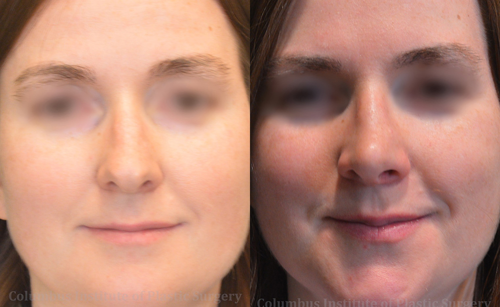 Rhinoplasty/Septoplasty before and after photo by Columbus Institute of Plastic Surgery in Columbus,
