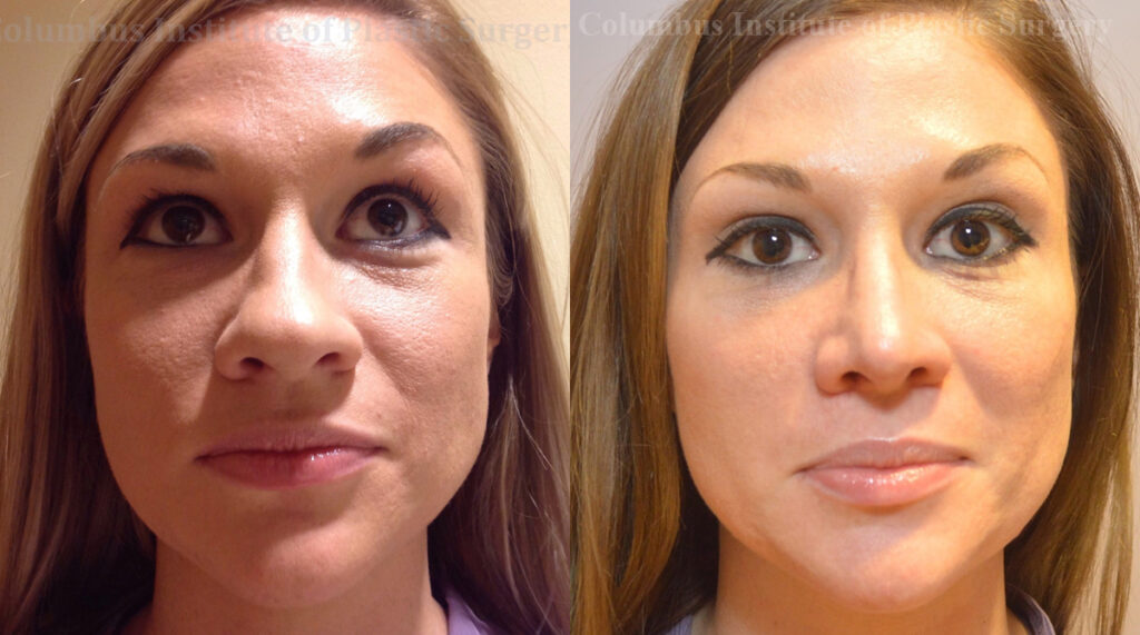 Rhinoplasty/Septoplasty before and after photo by Columbus Institute of Plastic Surgery in Columbus, OH