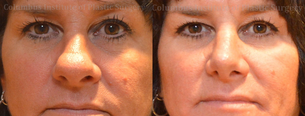 Rhinoplasty/Septoplasty before and after photo by Columbus Institute of Plastic Surgery in Columbus, OH