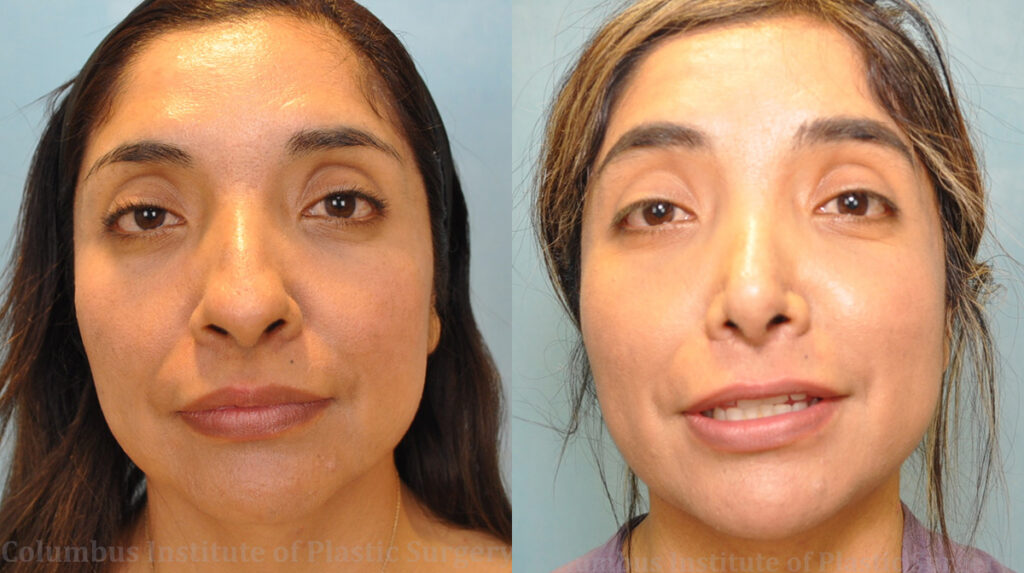 Rhinoplasty/Septoplasty before and after photo by Columbus Institute of Plastic Surgery in Columbus, OH