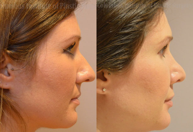 Rhinoplasty/Septoplasty before and after photo by Columbus Institute of Plastic Surgery in Columbus, OH