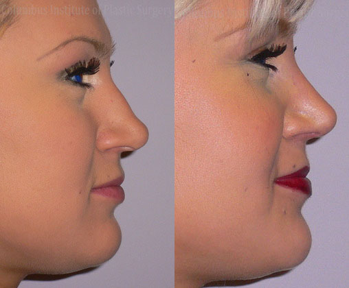 Rhinoplasty/Septoplasty before and after photo by Columbus Institute of Plastic Surgery in Columbus, OH