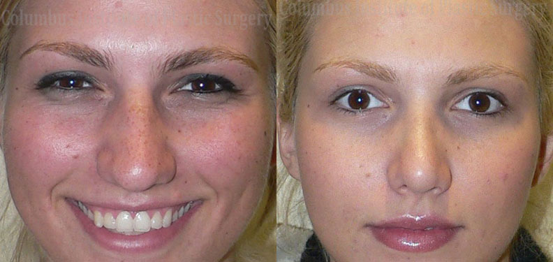 Rhinoplasty/Septoplasty before and after photo by Columbus Institute of Plastic Surgery in Columbus, OH
