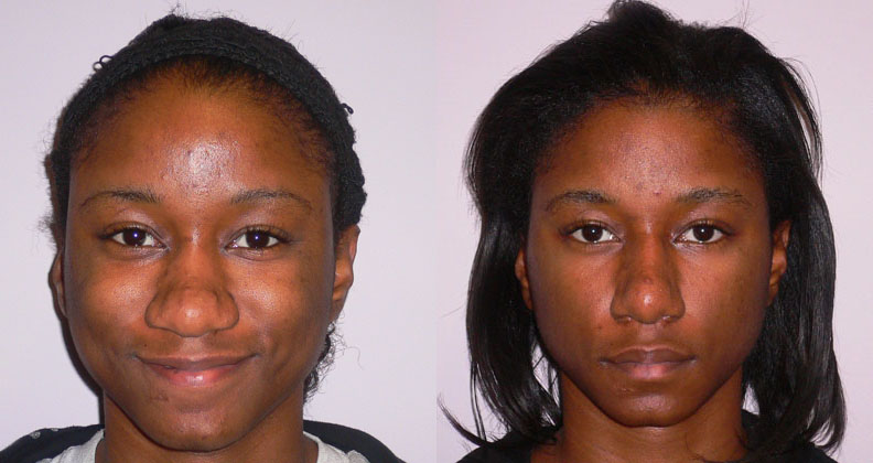 Rhinoplasty/Septoplasty before and after photo by Columbus Institute of Plastic Surgery in Columbus, OH
