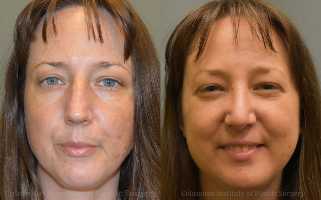 Rhinoplasty/Septoplasty before and after photo by Columbus Institute of Plastic Surgery in Columbus, OH