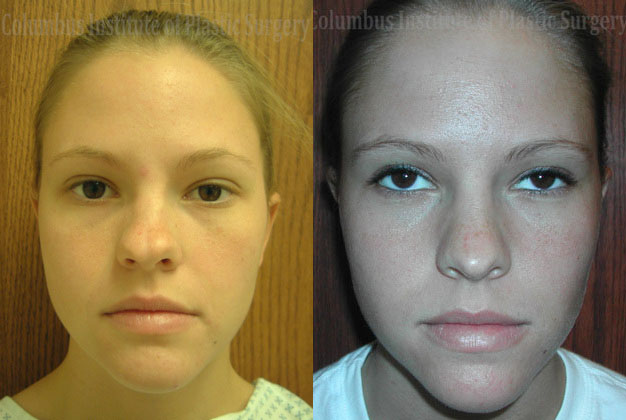 Rhinoplasty/Septoplasty before and after photo by Columbus Institute of Plastic Surgery in Columbus, OH