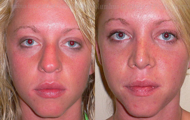 Rhinoplasty/Septoplasty before and after photo by Columbus Institute of Plastic Surgery in Columbus, OH