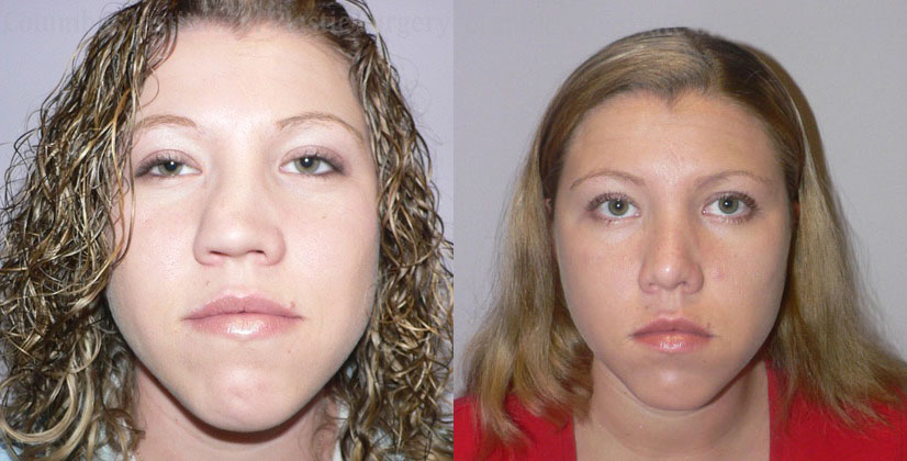 Rhinoplasty/Septoplasty before and after photo by Columbus Institute of Plastic Surgery in Columbus, OH