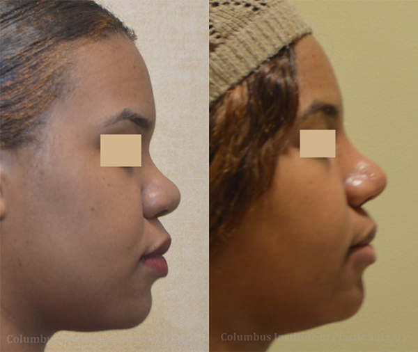 Rhinoplasty/Septoplasty before and after photo by Columbus Institute of Plastic Surgery in Columbus, OH