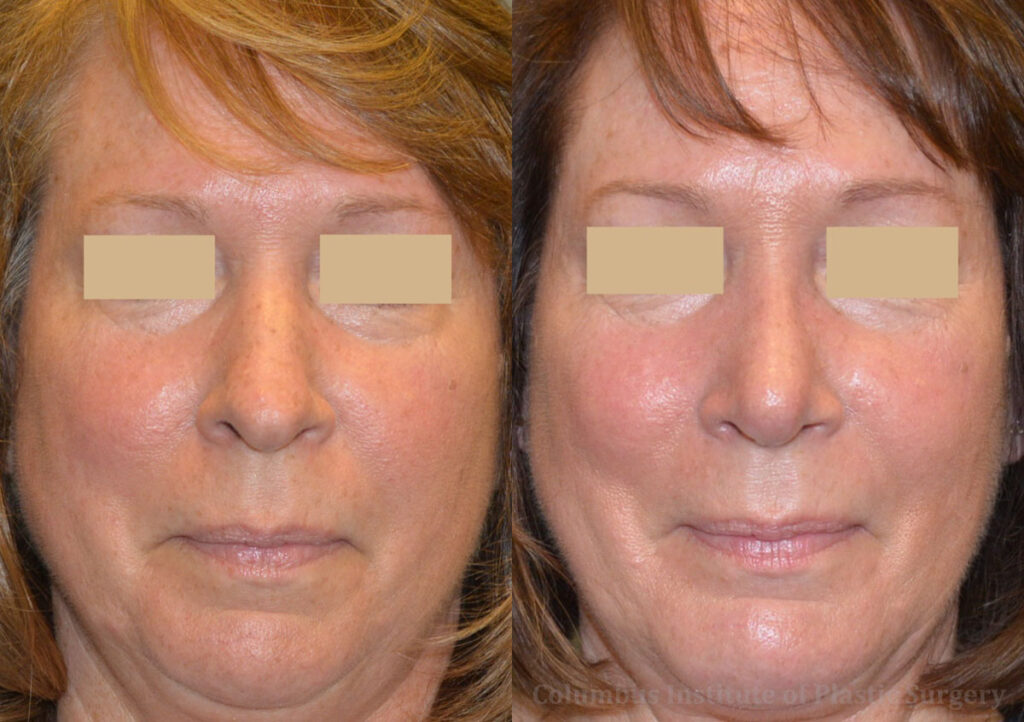 Rhinoplasty/Septoplasty before and after photo by Columbus Institute of Plastic Surgery in Columbus, OH