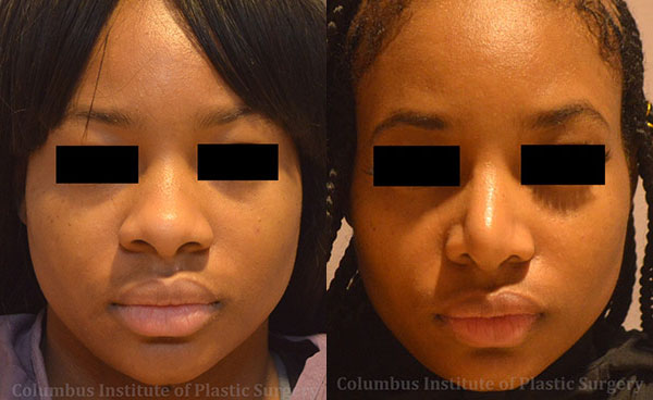 Rhinoplasty/Septoplasty before and after photo by Columbus Institute of Plastic Surgery in Columbus, OH