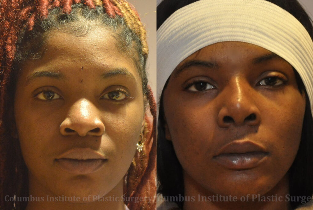 Rhinoplasty/Septoplasty before and after photo by Columbus Institute of Plastic Surgery in Columbus, OH