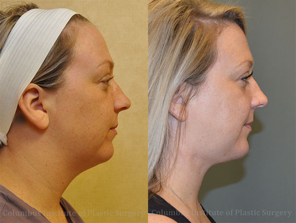 Surgical Facial Rejuvenation before and after photo by Columbus Institute of Plastic Surgery in Columbus, OH