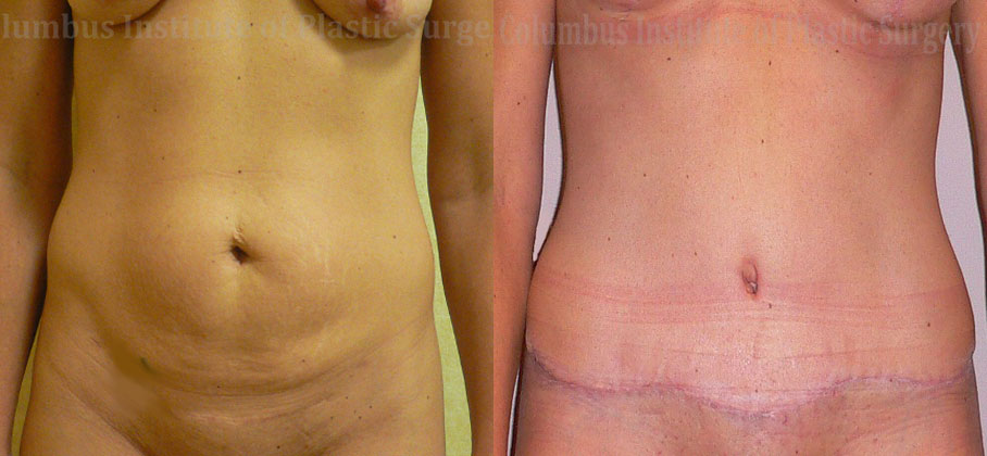 Abdominoplasty (Tummy Tuck) before and after photo by Columbus Institute of Plastic Surgery in Columbus, OH