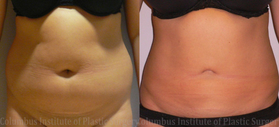 Liposuction before and after photo by Columbus Institute of Plastic Surgery in Columbus, OH