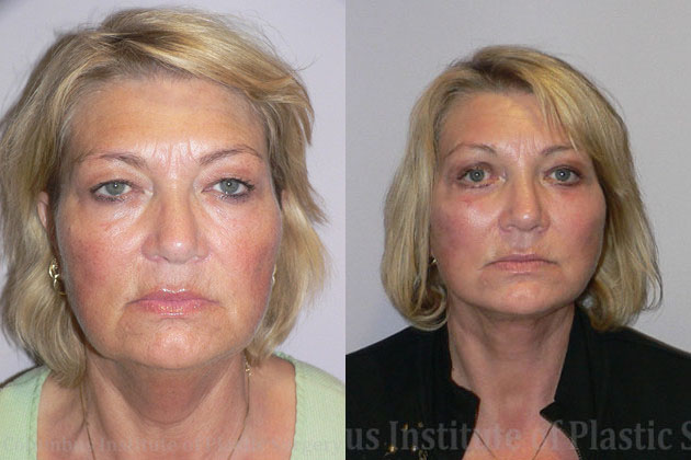 Surgical Facial Rejuvenation before and after photo by Columbus Institute of Plastic Surgery in Columbus, OH