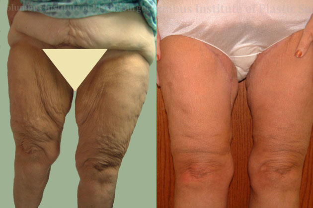 Thighplasty (Thigh Lift) before and after photo by Columbus Institute of Plastic Surgery in Columbus, OH