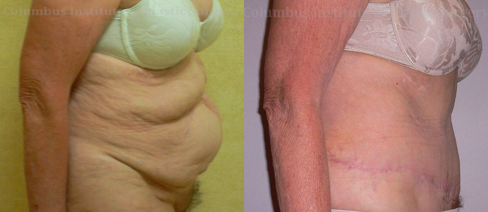 Abdominoplasty (Tummy Tuck) before and after photo by Columbus Institute of Plastic Surgery in Columbus, OH