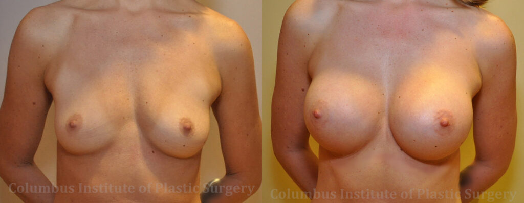 Breast Augmentation before and after photo by Columbus Institute of Plastic Surgery in Columbus, OH