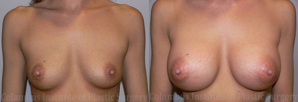 Breast Augmentation – 300cc-400cc before and after photo by Columbus Institute of Plastic Surgery in Columbus, OH