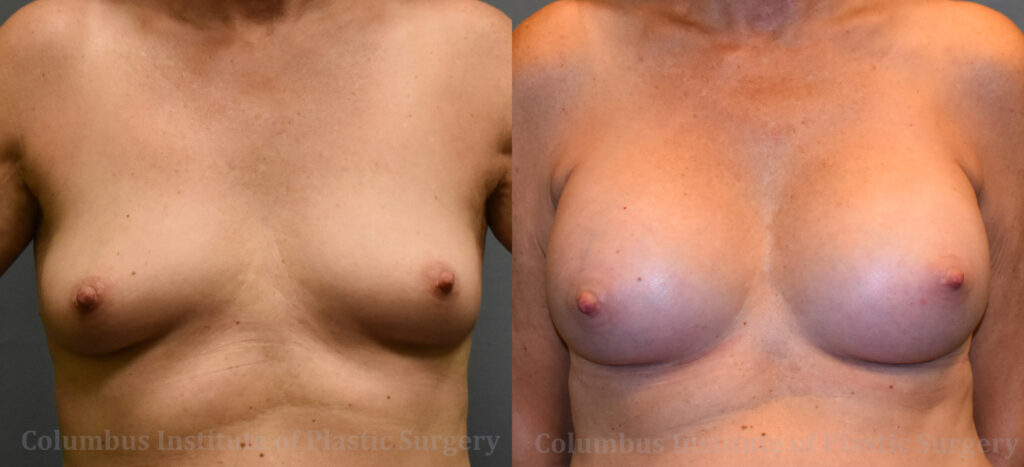 Breast Augmentation – 400cc-500cc before and after photo by Columbus Institute of Plastic Surgery in Columbus, OH