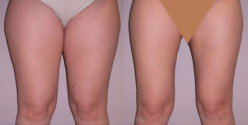 Liposuction before and after photo by Columbus Institute of Plastic Surgery in Columbus, OH