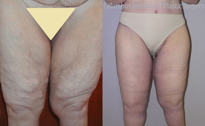 Thighplasty (Thigh Lift) before and after photo by Columbus Institute of Plastic Surgery in Columbus, OH