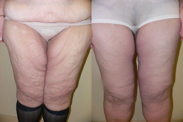 Thighplasty (Thigh Lift) before and after photo by Columbus Institute of Plastic Surgery in Columbus, OH