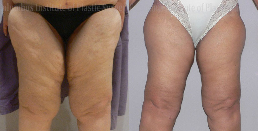 Thighplasty (Thigh Lift) before and after photo by Columbus Institute of Plastic Surgery in Columbus, OH
