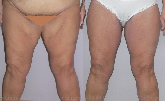 Thighplasty (Thigh Lift) before and after photo by Columbus Institute of Plastic Surgery in Columbus, OH