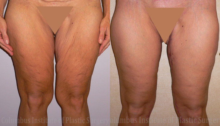 Thighplasty (Thigh Lift) before and after photo by Columbus Institute of Plastic Surgery in Columbus, OH