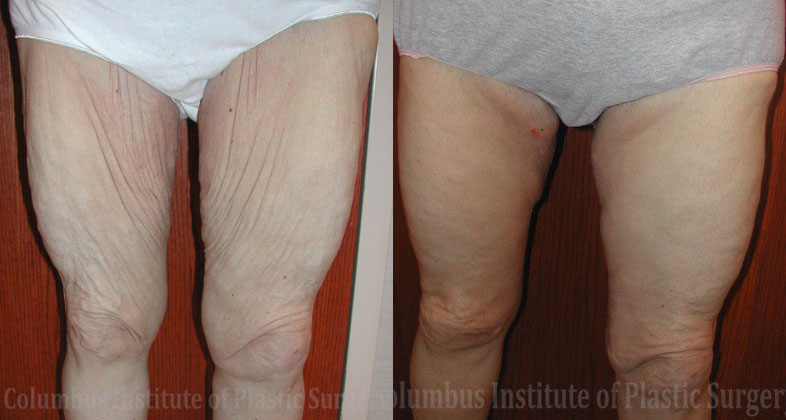 Thighplasty (Thigh Lift) before and after photo by Columbus Institute of Plastic Surgery in Columbus, OH