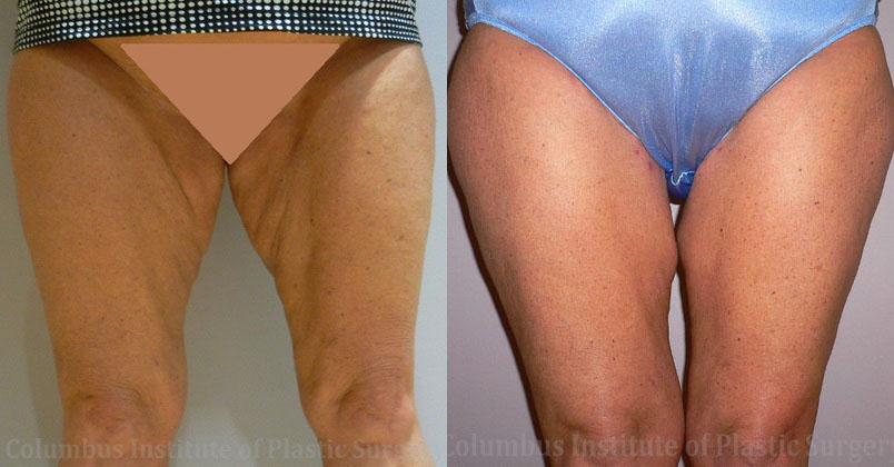 Thighplasty (Thigh Lift) before and after photo by Columbus Institute of Plastic Surgery in Columbus, OH