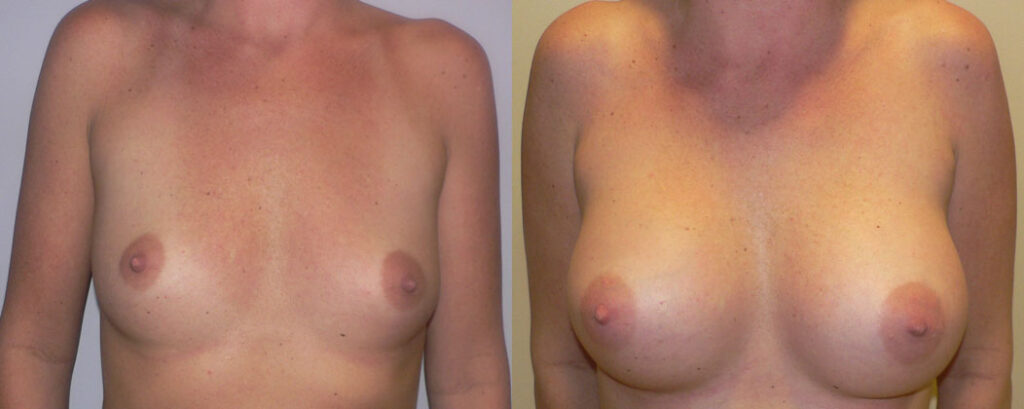 Breast Augmentation – 300cc-400cc before and after photo by Columbus Institute of Plastic Surgery in Columbus, OH