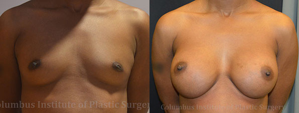Breast Augmentation – 400cc-500cc before and after photo by Columbus Institute of Plastic Surgery in Columbus, OH