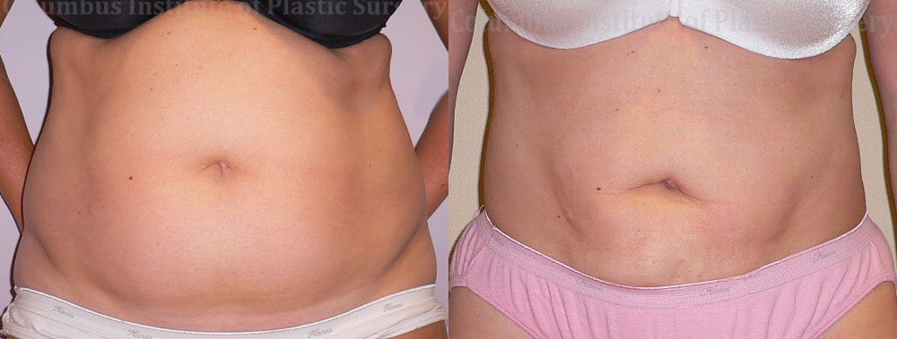 Liposuction before and after photo by Columbus Institute of Plastic Surgery in Columbus, OH